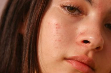 How Does Transition From Child To Teen To Adult Affect Your Skin?