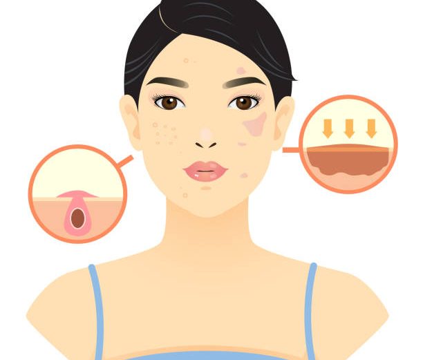 What is hyperpigmentation