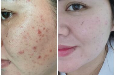 Acne Myths vs. Facts: Debunking Common Misconceptions