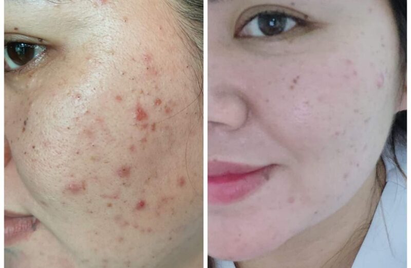 Acne Myths vs. Facts: Debunking Common Misconceptions