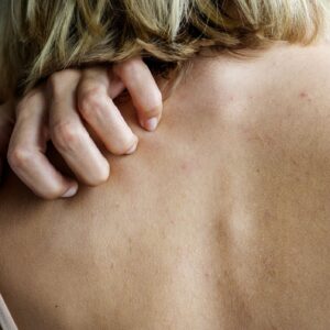 Skin Inflammation