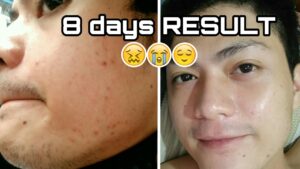 Before and After Using RDL Baby Face Hydroquinone + Tretinoin Astringent