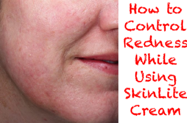 How To lessen Redness While Using SkinLite Cream