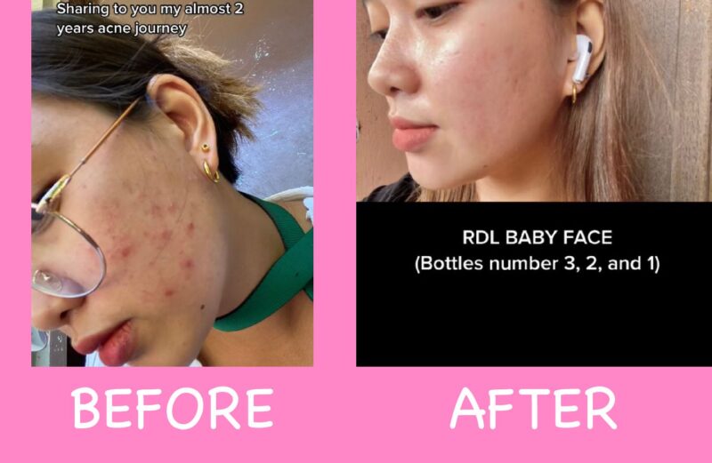 RDL Baby Face Astringents Before and After