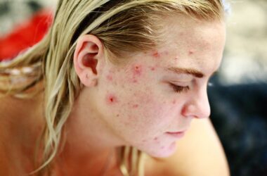 Clear Skin Ahead: Tips for Preventing Pimples