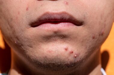 How Diet and Lifestyle Choices Impact Acne