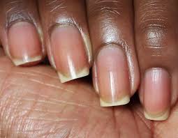 Uncover the Causes of Discolored Nails and How to Restore Their Natural Beauty